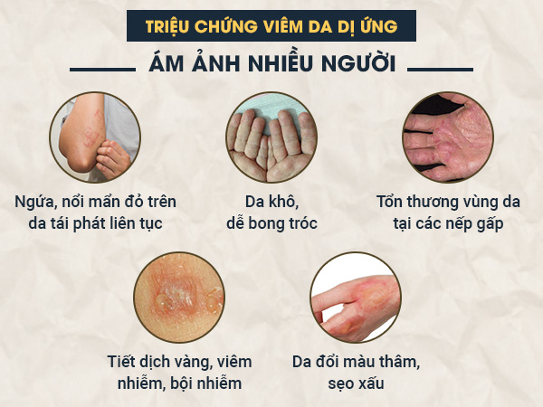 Viêm da dị ứng là gì?