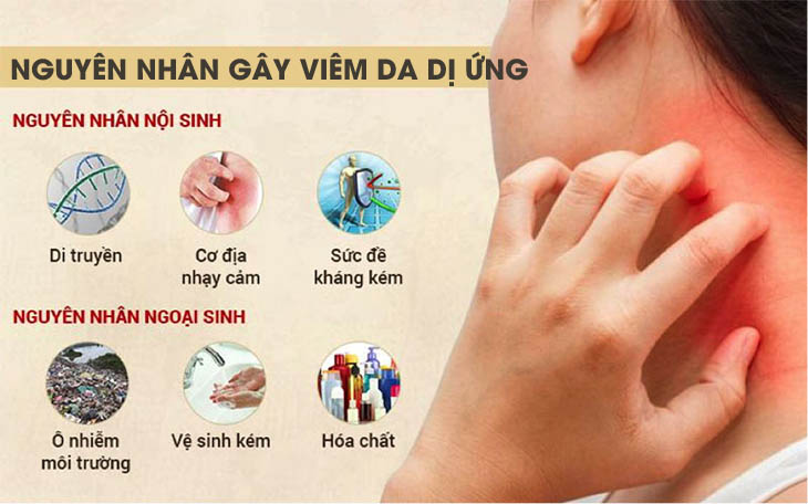 Viêm da dị ứng là gì?