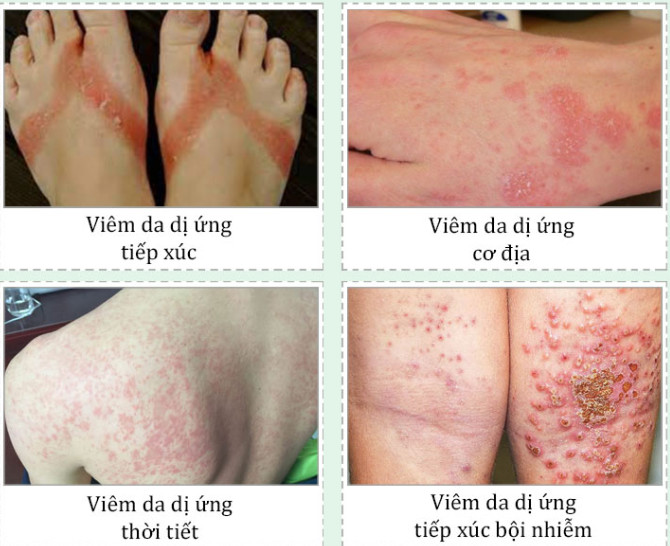 Viêm da dị ứng là gì?