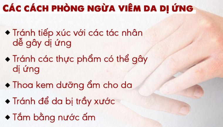 Viêm da dị ứng là gì?