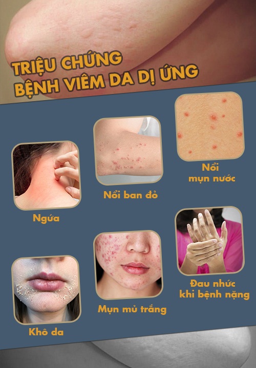 Viêm da dị ứng có lây không?