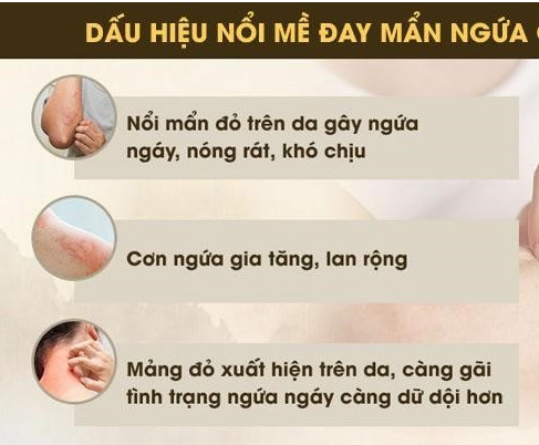 Mẩn ngứa mề đay