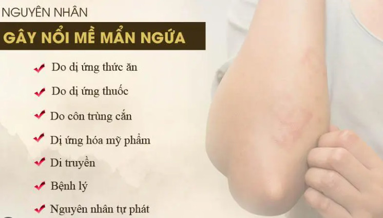 Mẩn ngứa mề đay