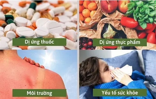 cách chữa mẩn ngứa mề đay tại nhà