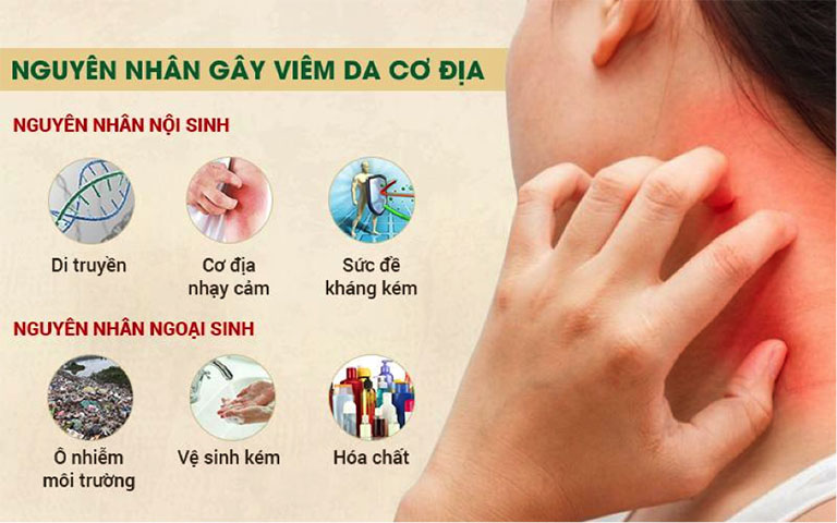 Viêm da cơ địa