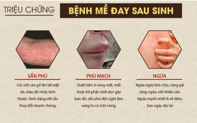 Nổi mẩn ngứa mề đay sau sinh