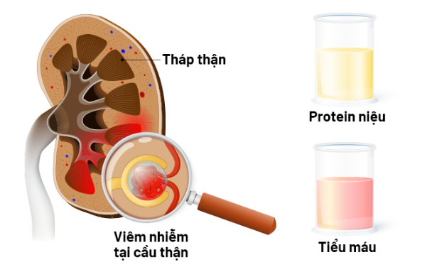 Viêm mao mạch dị ứng có chữa được không?