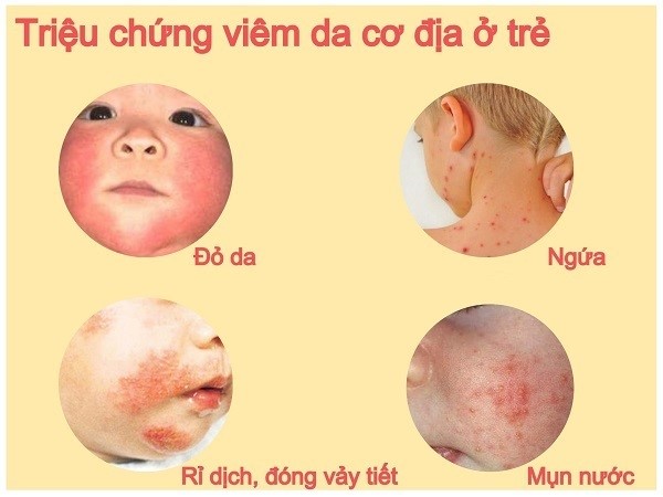 Viêm da cơ địa ở trẻ em