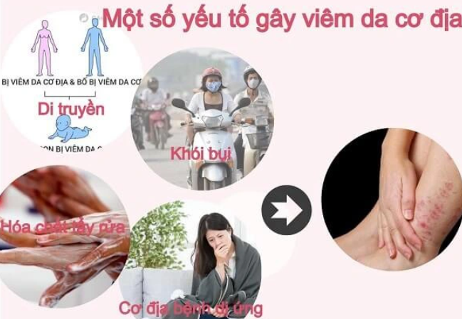 Viêm da cơ địa tái phát