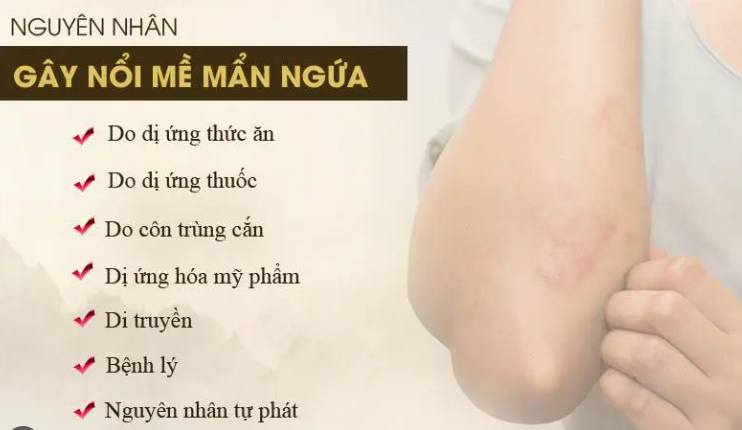 Mẩn ngứa mề đay tự phát