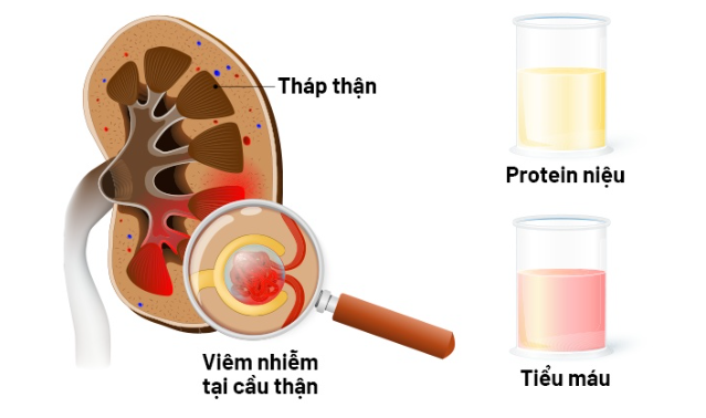 Biến chứng bệnh thận do viêm mao mạch dị ứng và phác đồ điều trị mới nhất