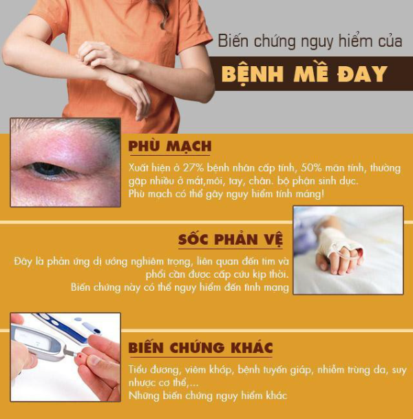 Nổi mẩn ngứa mề đay vào ban đêm