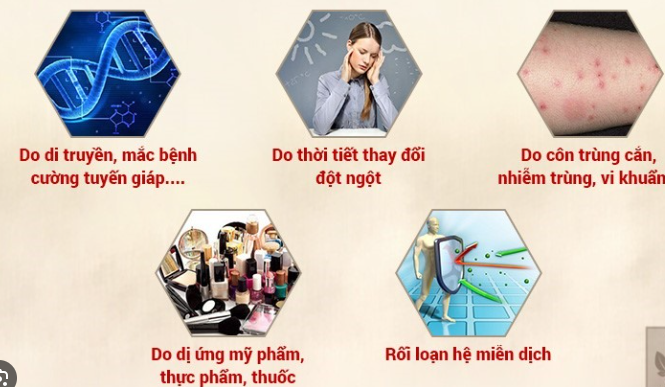 Nổi mẩn ngứa mề đay vào ban đêm