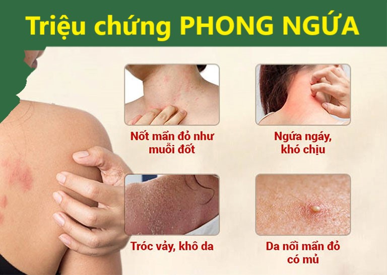 Phong ngứa