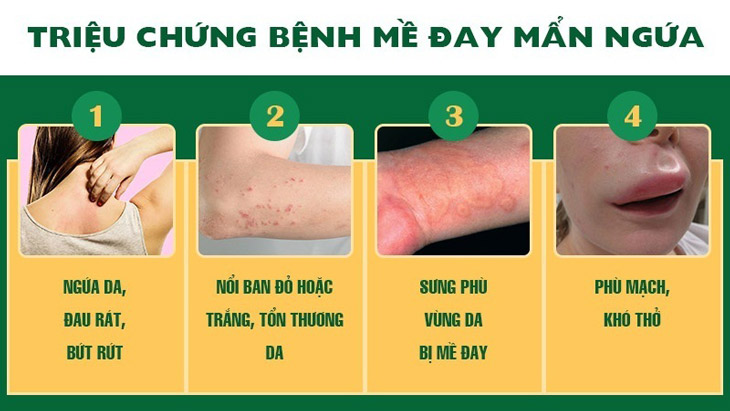 Nổi mề đay sưng môi