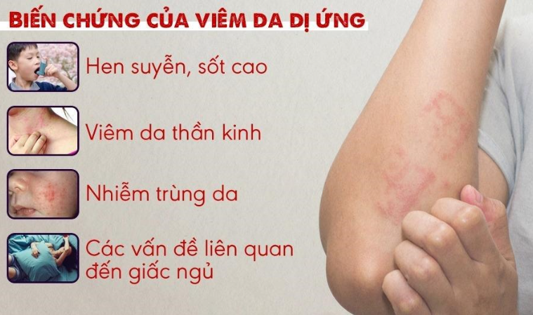 Viêm da dị ứng ở tay chân