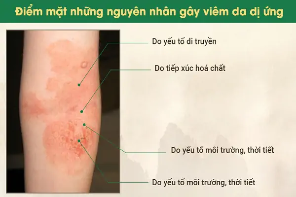 chữa viêm da dị ứng ở bà bầu