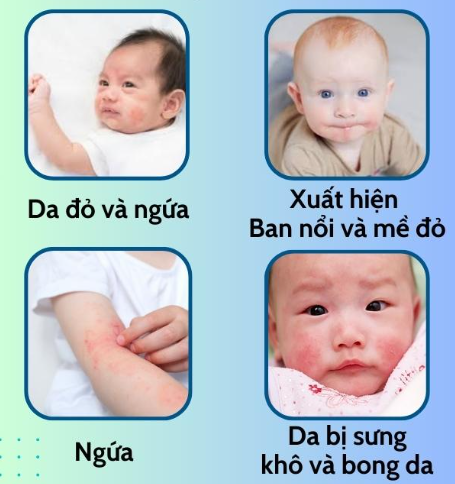 Viêm da dị ứng ở trẻ sơ sinh