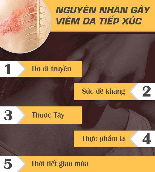 Viêm da tiếp xúc ánh sáng