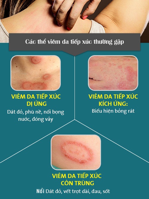 phân biệt bệnh viêm da tiếp xúc và zona thần kinh