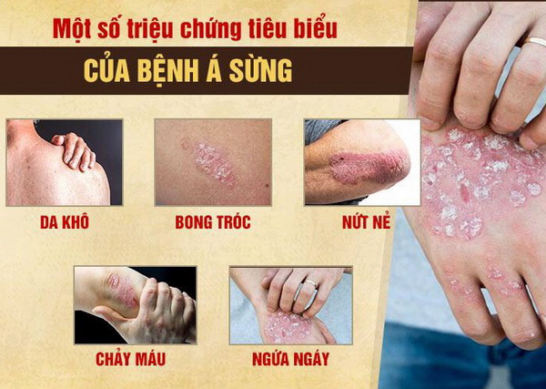 Viêm da cơ địa á sừng