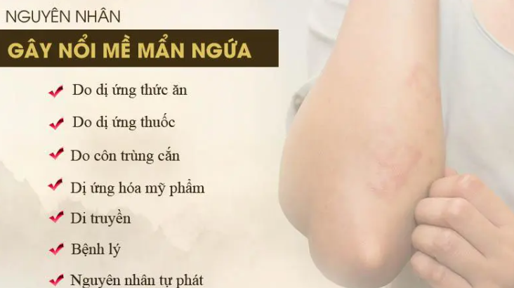 Bị mẩn ngứa mề đay có cần kiêng nước không? 