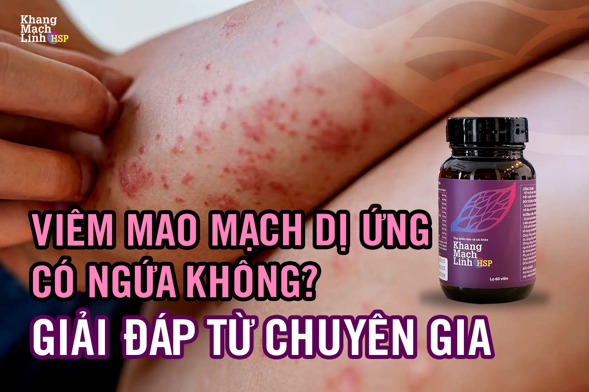 Viêm mao mạch dị ứng có ngứa không? Giải đáp từ chuyên gia