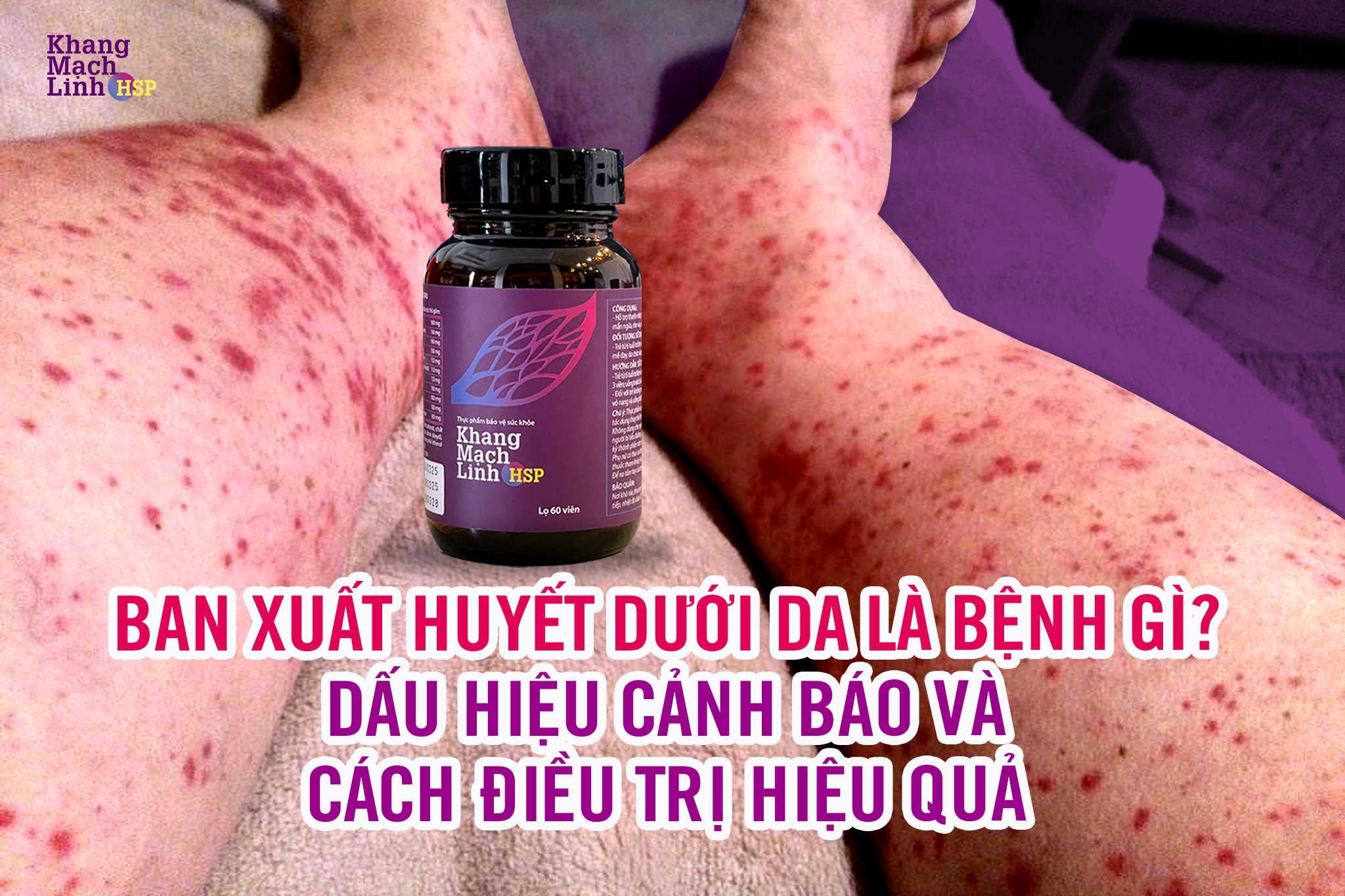 Ban xuất huyết dưới da là bệnh gì? Dấu hiệu cảnh báo và cách điều trị hiệu quả