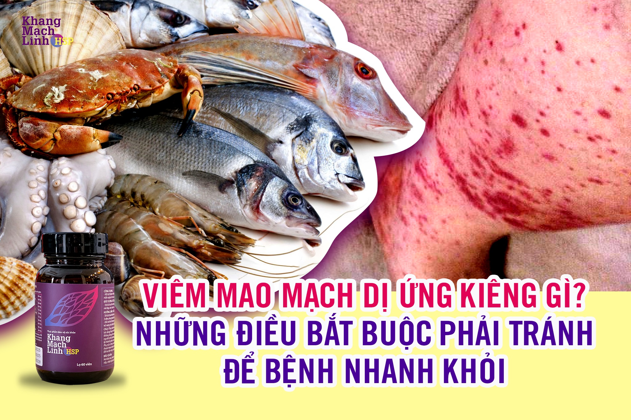 Viêm mao mạch dị ứng kiêng gì? Những điều bắt buộc phải tránh để bệnh nhanh khỏi