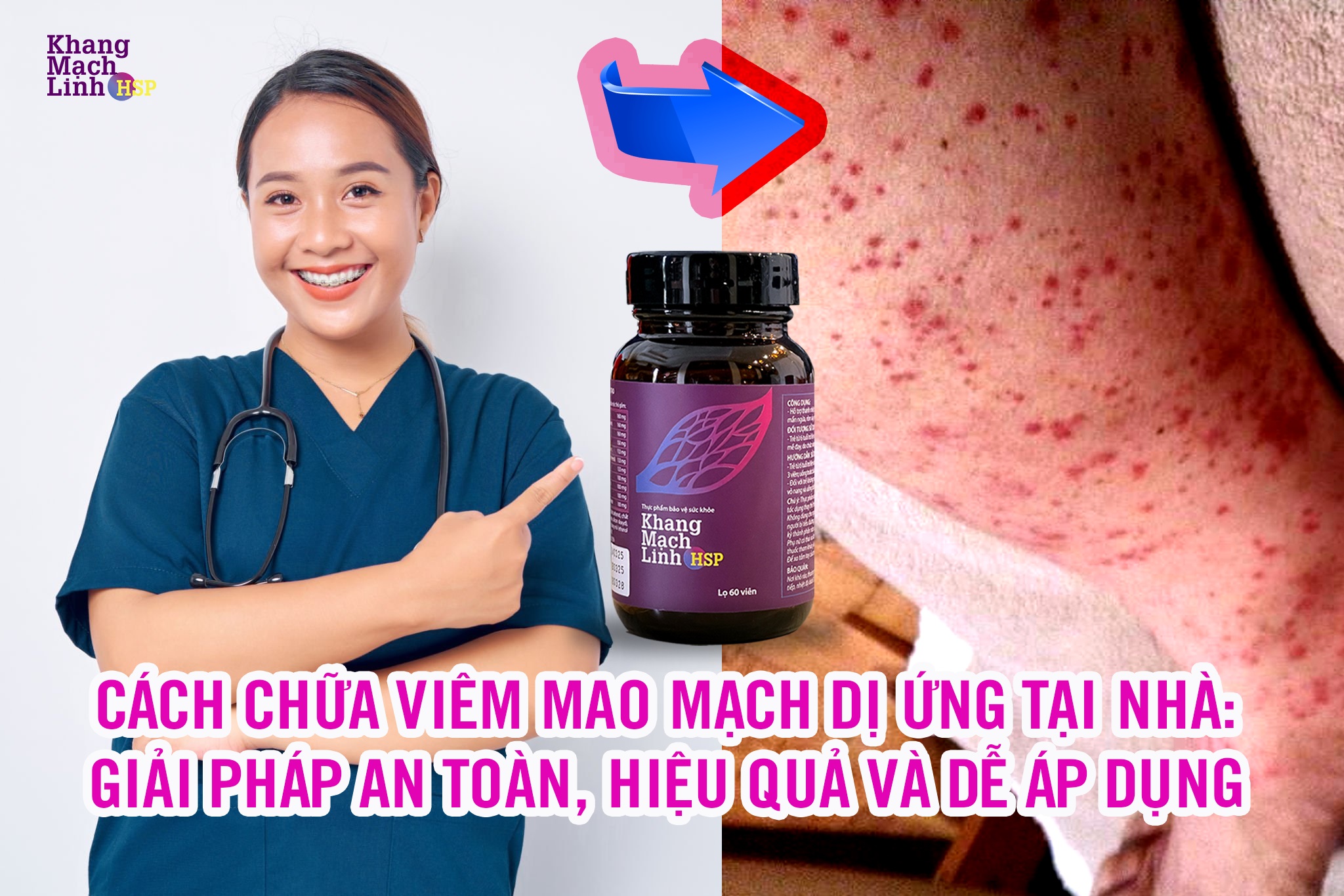 Cách chữa viêm mao mạch dị ứng tại nhà: Giải pháp an toàn, hiệu quả và dễ áp dụng