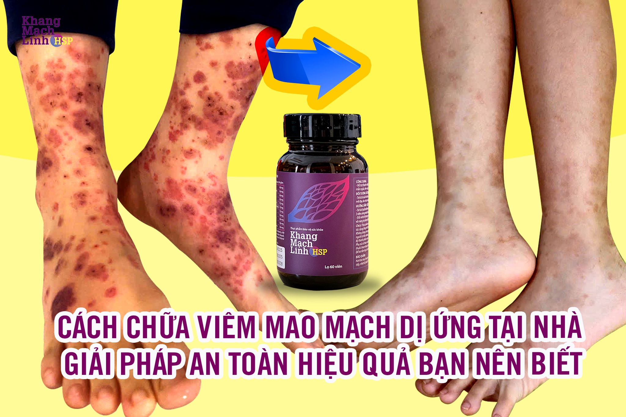Cách chữa viêm mao mạch dị ứng tại nhà: Giải pháp an toàn, hiệu quả bạn nên biết