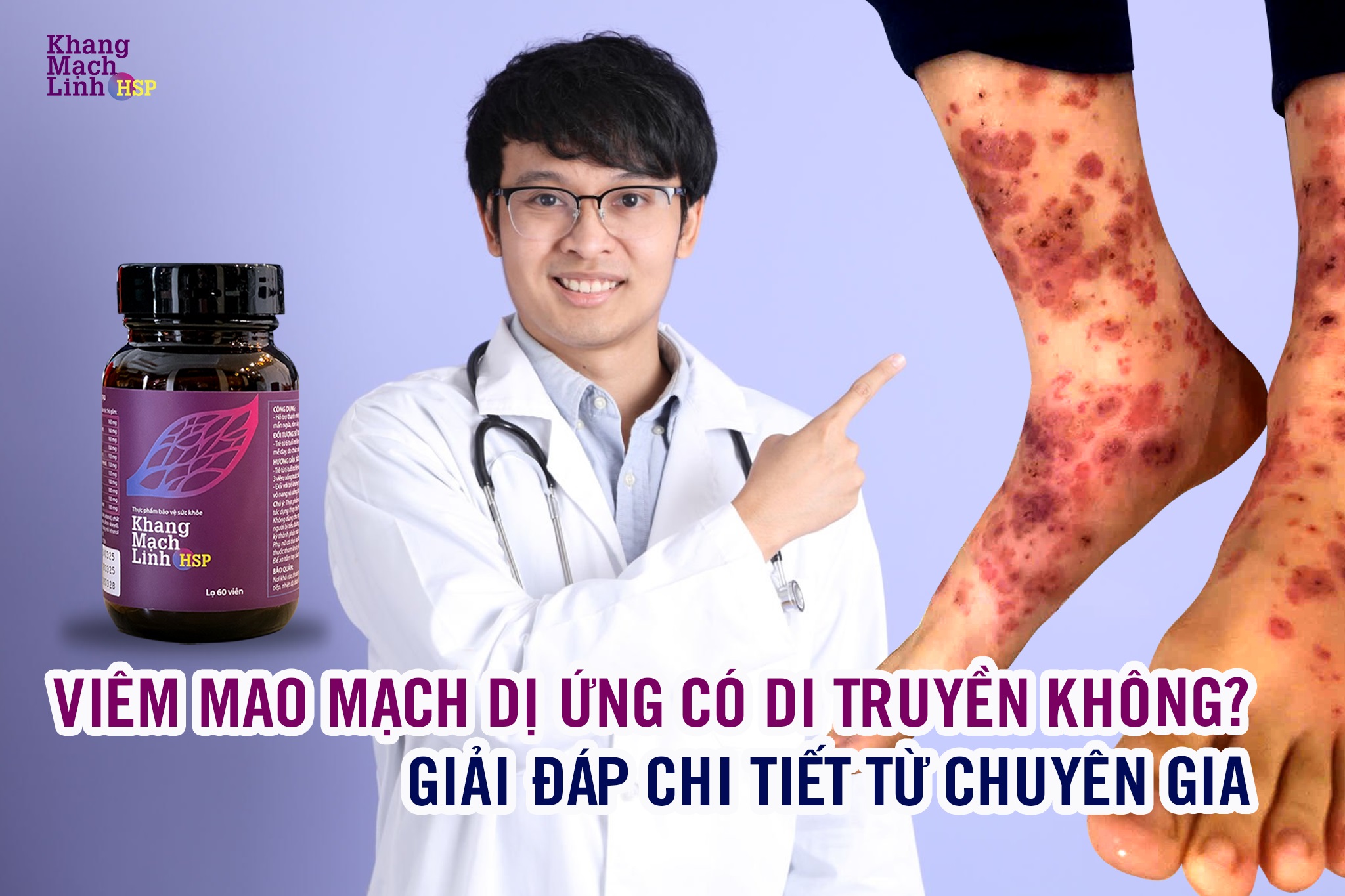 Viêm mao mạch dị ứng có di truyền không? Giải đáp chi tiết từ chuyên gia
