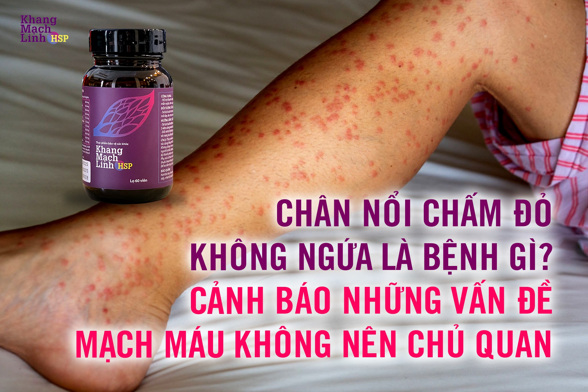 Chân nổi chấm đỏ không ngứa là bệnh gì? Cảnh báo những vấn đề mạch máu không nên chủ quan